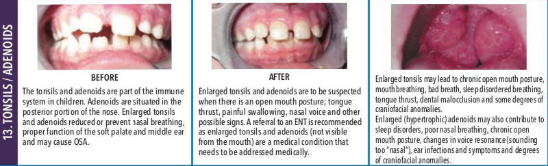 Tonsils:Adenoids
