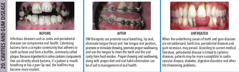 Cavities and Gum Disease